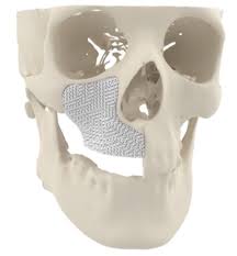 3D-Printed Bones