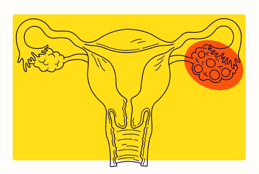 pcos