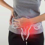 pcos