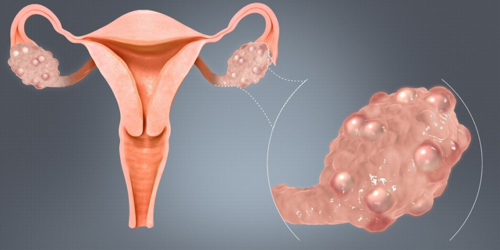 pcos