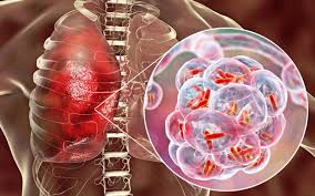 tuberclosis