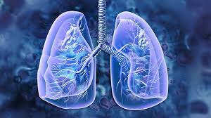 lung cancer